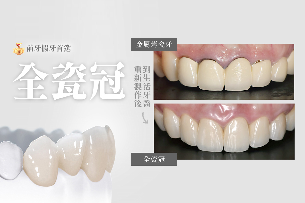 【全瓷冠是什麼？適應症、材質、流程一次解析】全瓷牙冠專業懶人包｜台中牙醫推薦