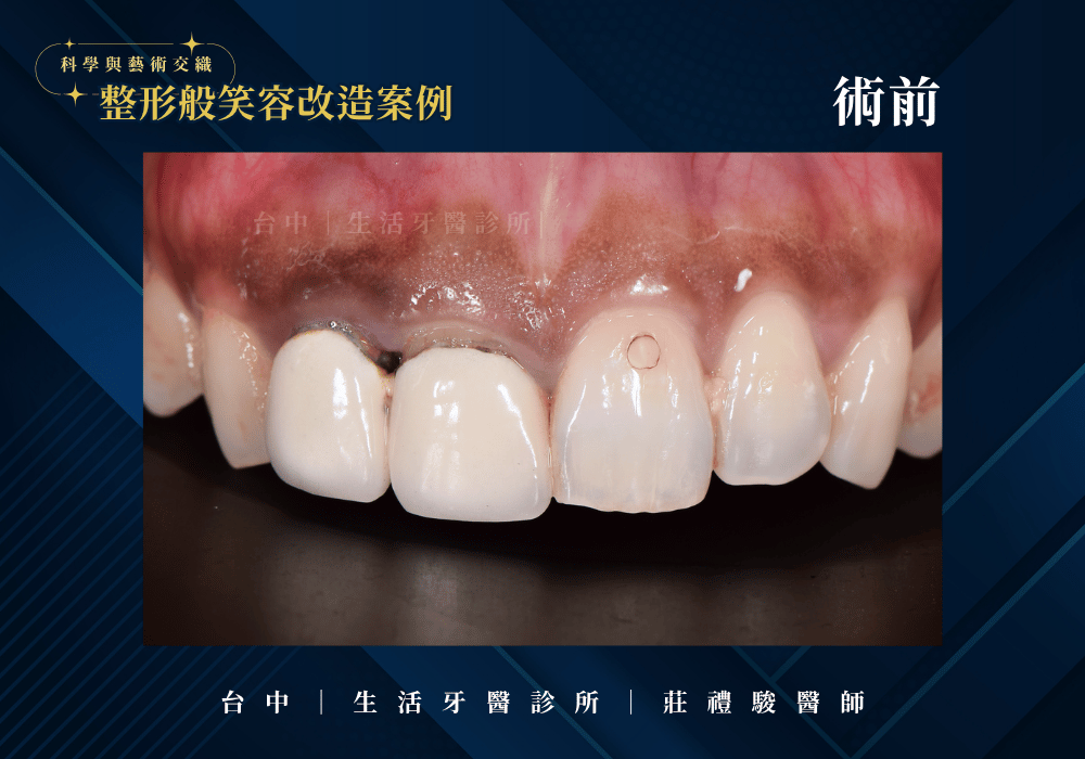 【案例分享】全瓷冠+牙冠增長術,找回對稱自然的笑容|台中生活牙醫 莊禮駿醫師