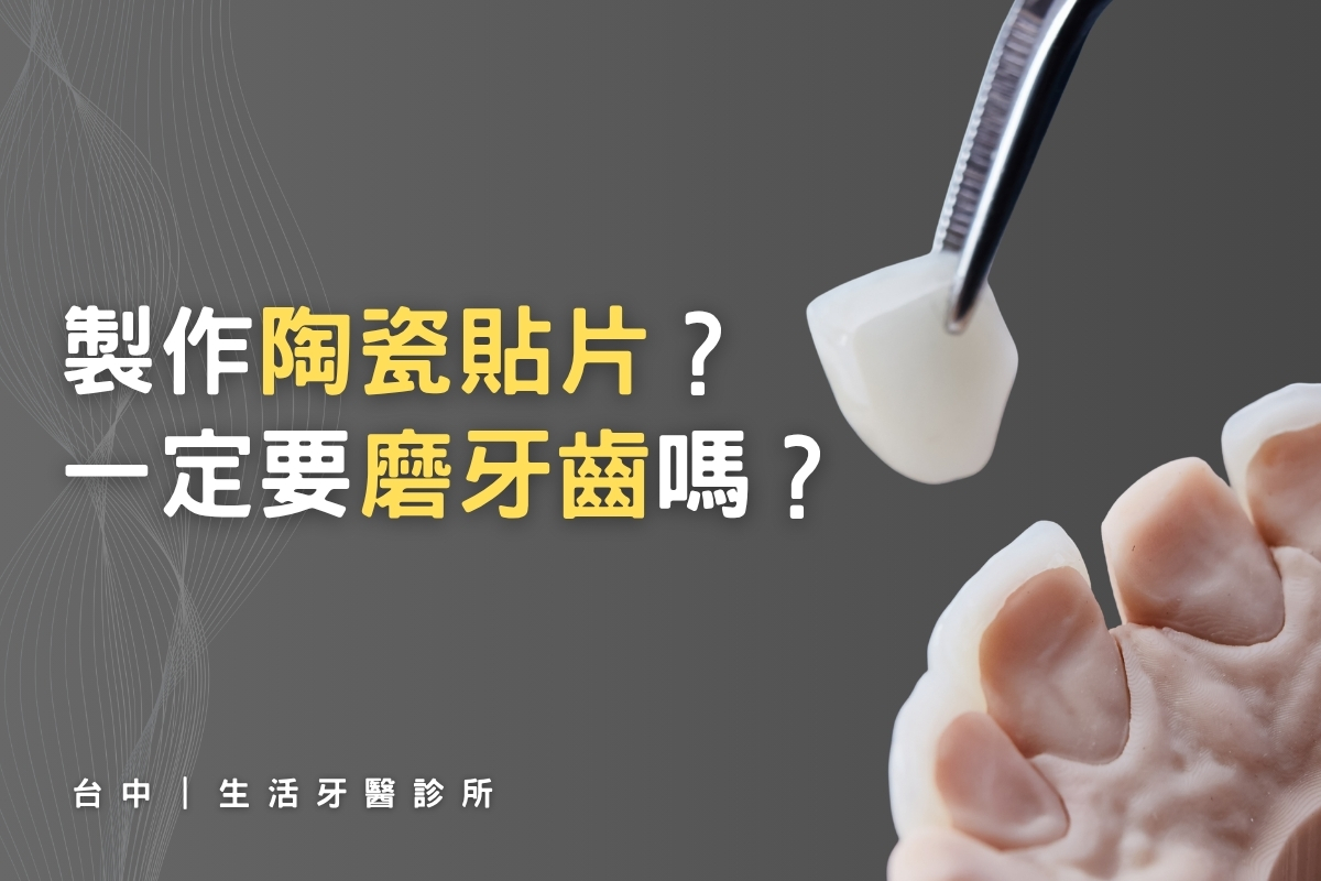 製作陶瓷美齒貼片一定要磨牙齒嗎？台中專業牙醫來解答！｜生活牙醫診所