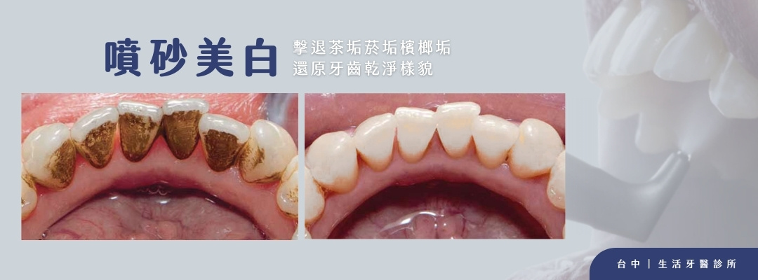 台中南投生活牙醫噴砂美白適合有咖啡、茶、菸或檳榔色素沉積的族群
