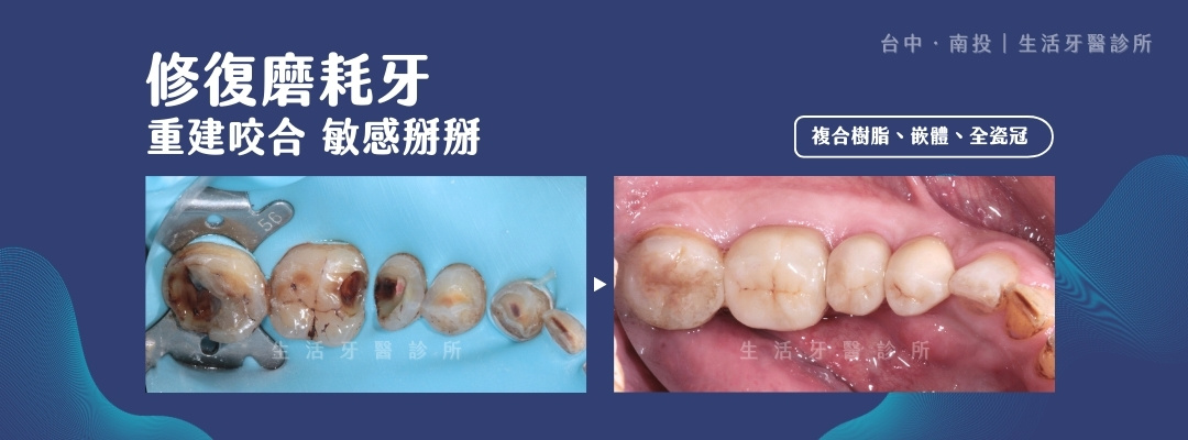 台中南投生活牙醫磨耗牙齒使用複合樹脂、陶瓷嵌體與全瓷冠修復前後比較