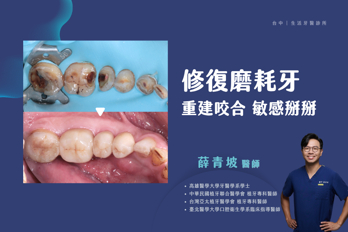台中南投生活牙醫薛青坡醫師磨耗牙齒修復與咬合重建案例