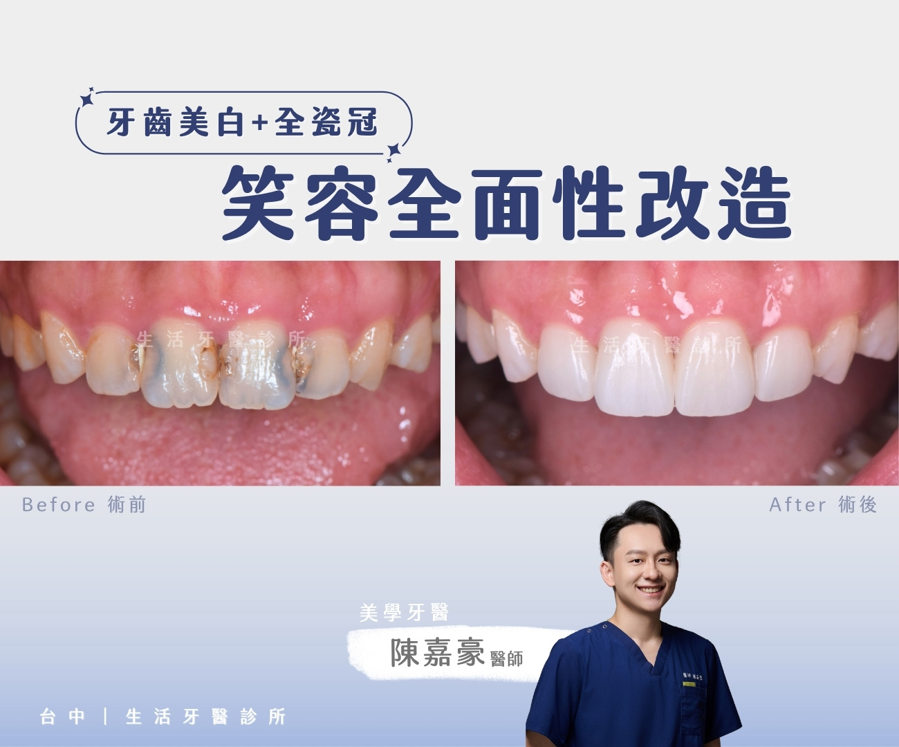 台中生活牙醫陳嘉豪醫師全瓷冠與居家美白案例-術前術後對比圖
