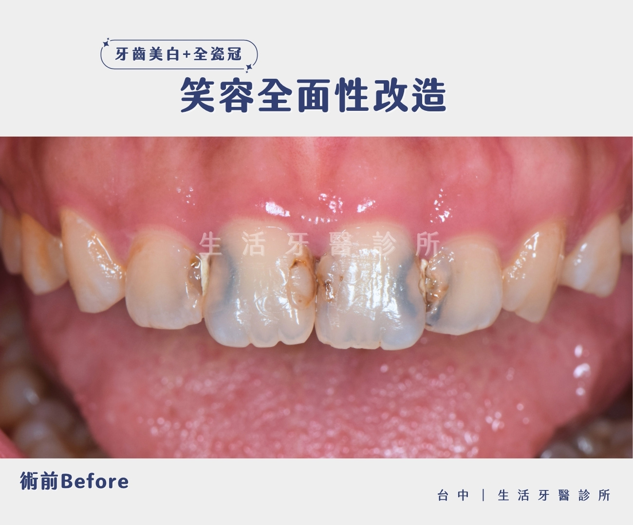 台中生活牙醫全瓷冠假牙加牙齒美白治療門牙蛀牙牙齒變黑