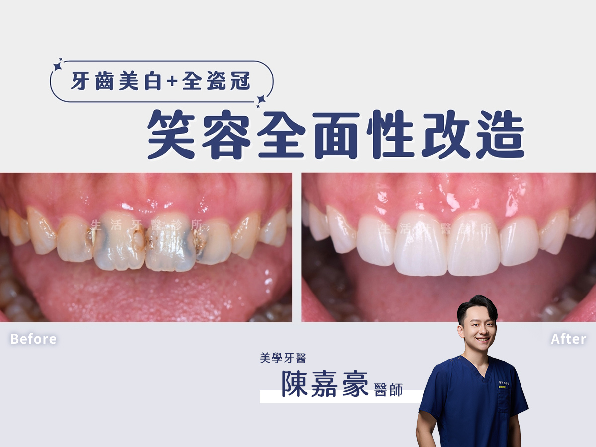 【前牙美學案例】告別門牙蛀牙變黑：全瓷冠搭配美白，笑容全面改造