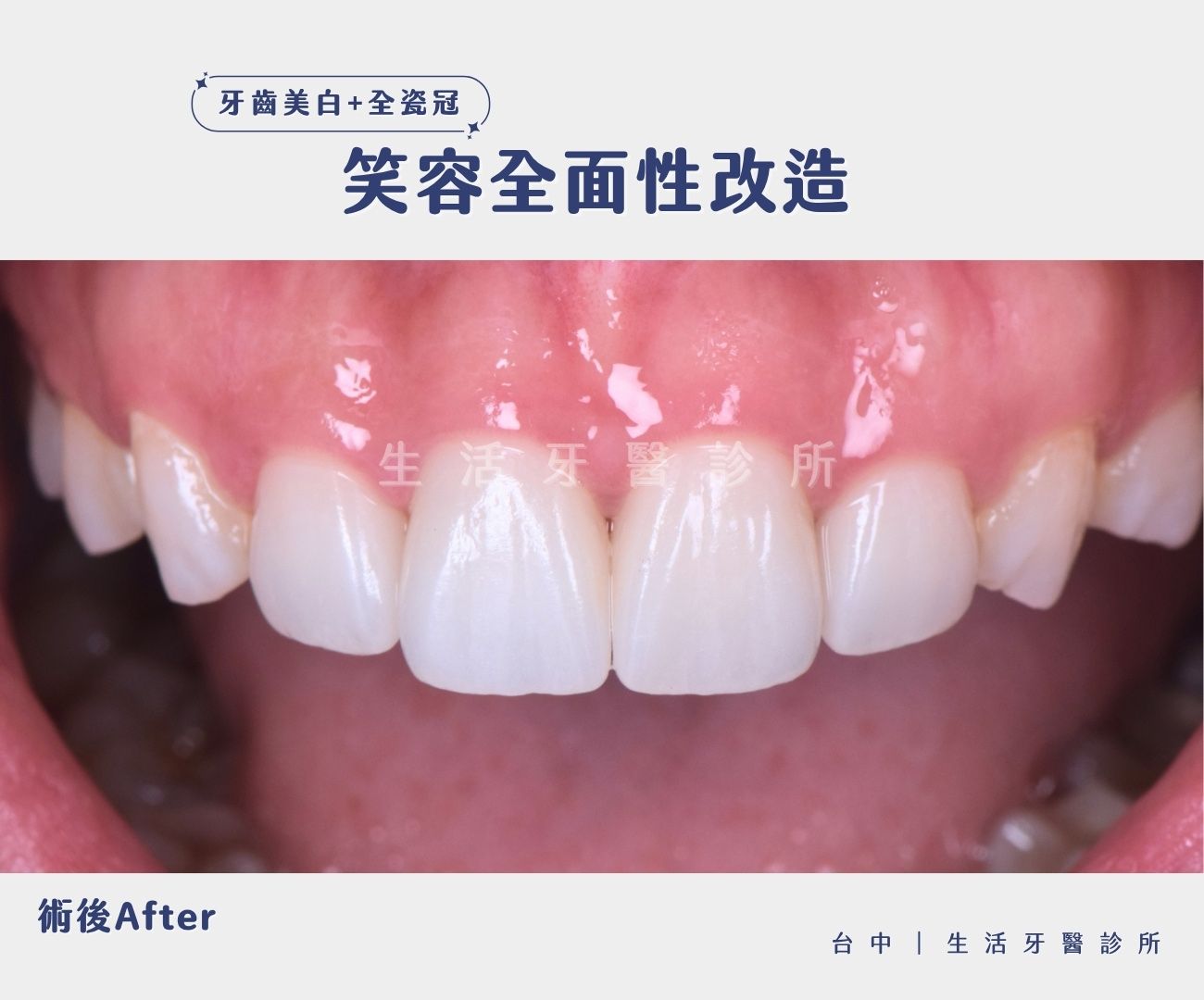 台中生活牙醫全瓷冠假牙加牙齒美白治療門牙蛀牙牙齒變黑