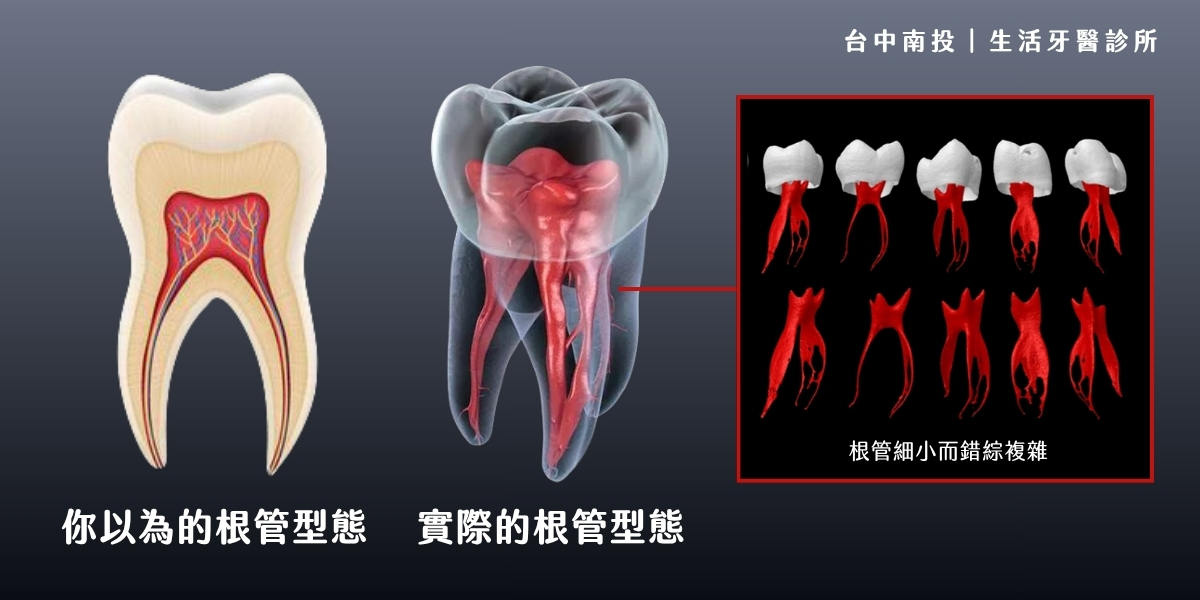 台中南投生活牙醫牙科顯微鏡輔助根管治療示意