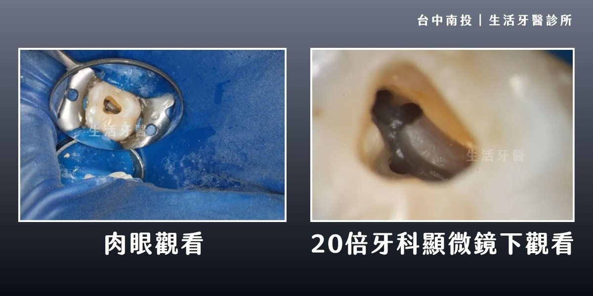 台中南投生活牙醫顯微根管治療適用情況整理