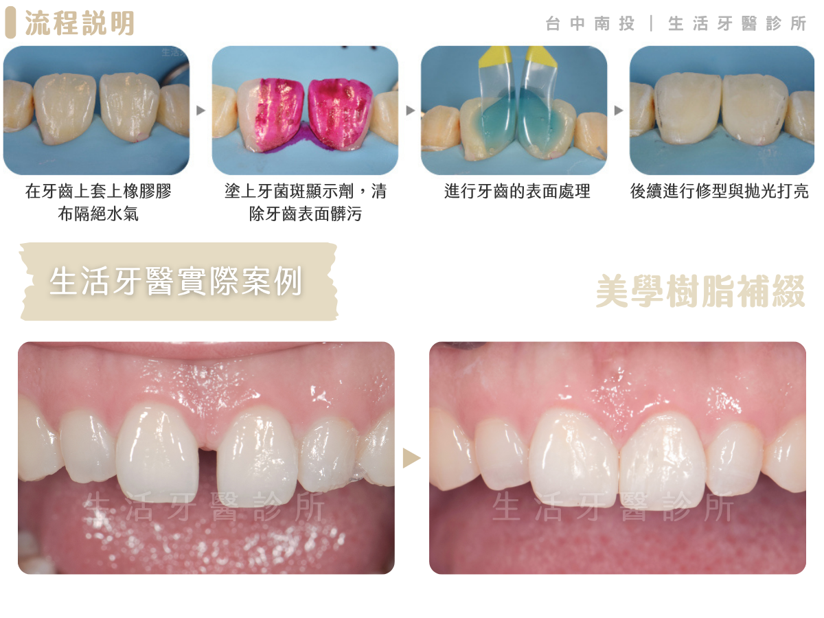 台中南投生活牙醫樹脂補牙縫改善前牙牙縫示意