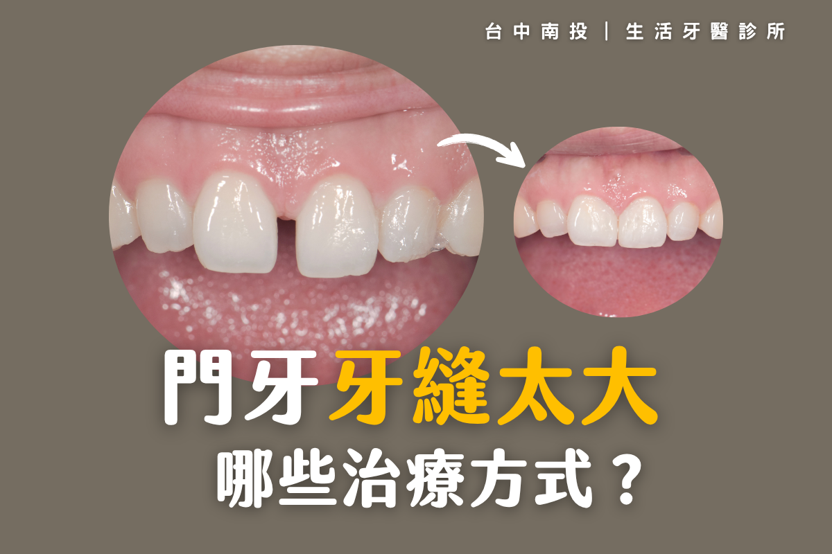 台中南投生活牙醫門牙牙縫過大治療方式比較