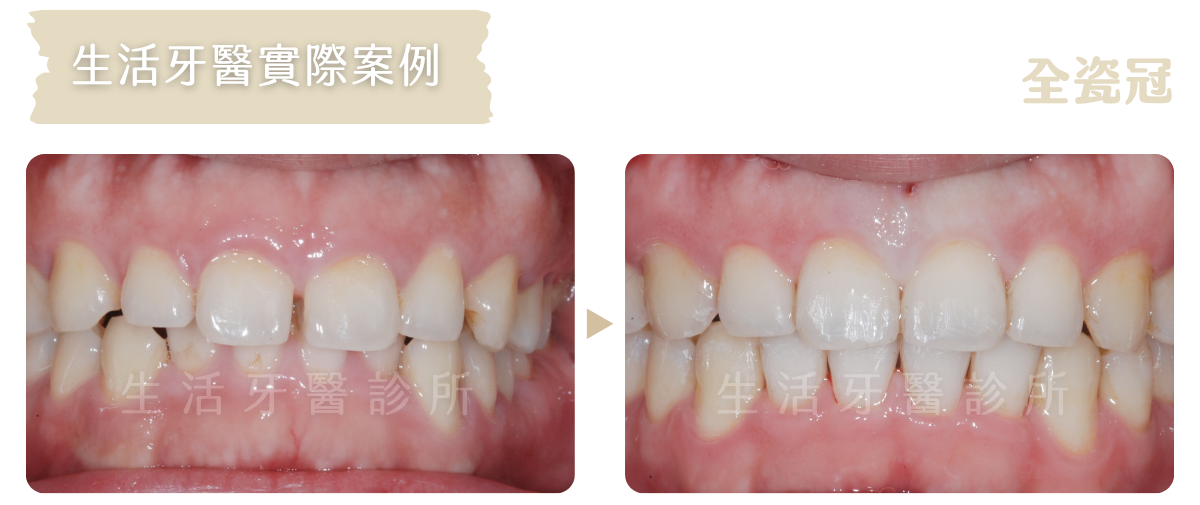 台中南投生活牙醫矯正治療改善門牙牙縫示意
