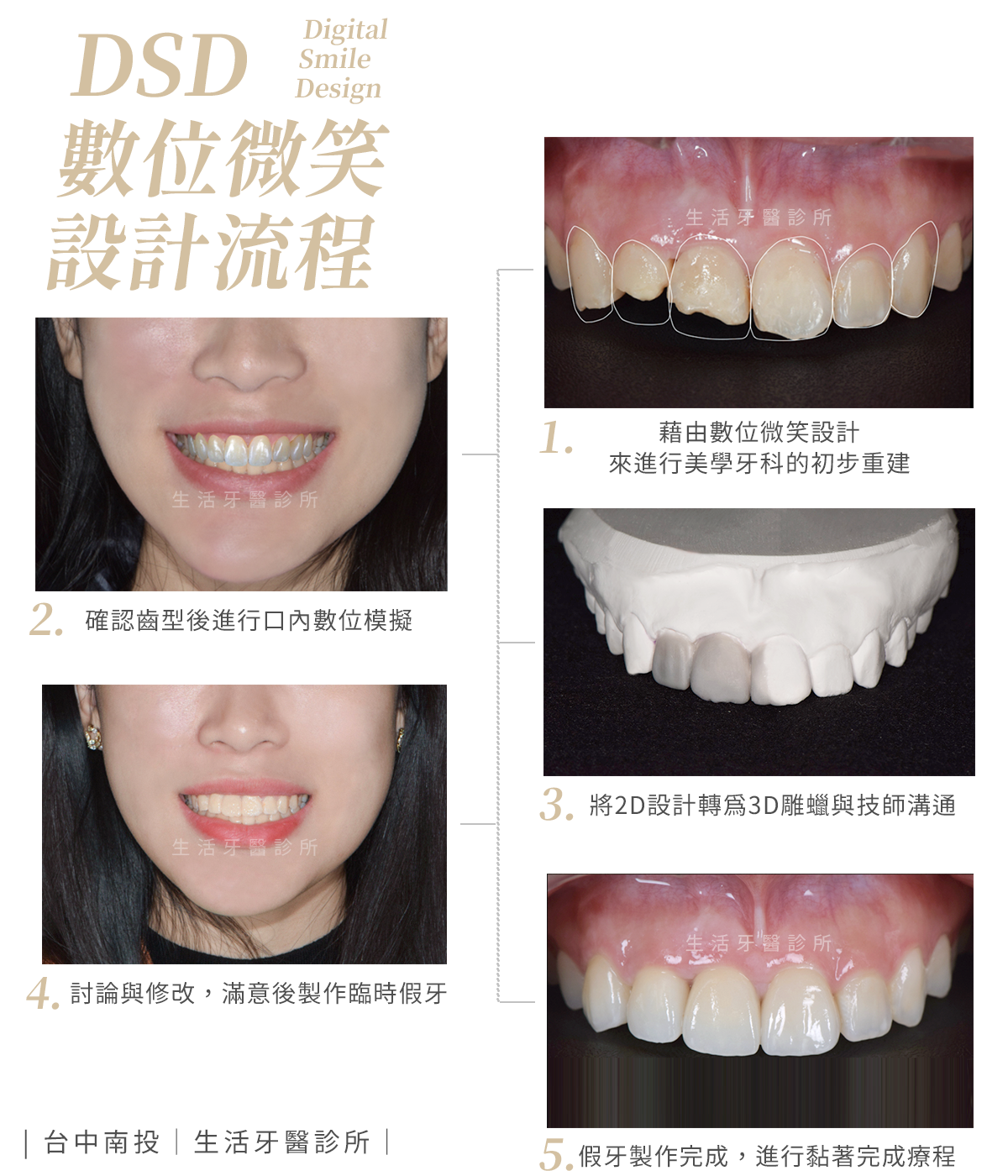 台中南投生活牙醫DSD 數位微笑設計前牙療程案例